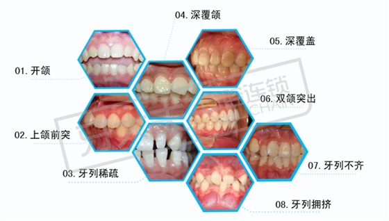 牙齿矫正类型_副本.png