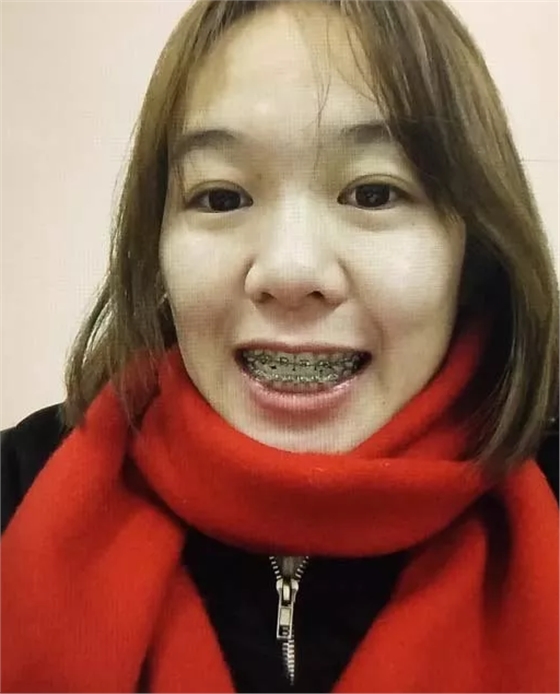 牙套日记牙套照片 牙套日记牙套照片