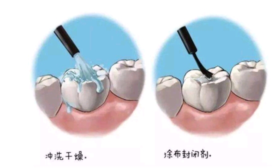 长沙窝沟封闭