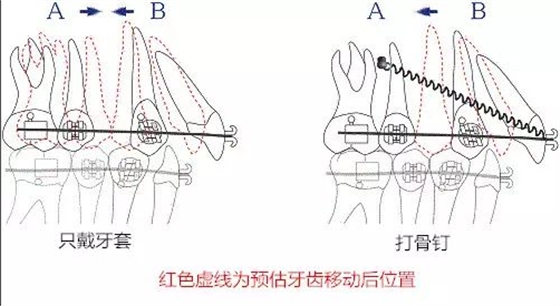 矫正效果